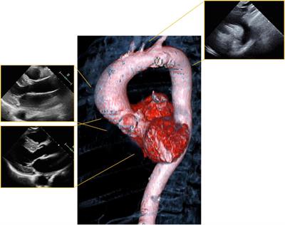 Cardiovascular Imaging in Pregnancy: Valvulopathy, Hypertrophic Cardiomyopathy, and Aortopathy